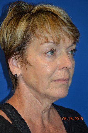 FACEology Lift / Neck Lift Case 4170 Before Photo FACEology Lift / Neck Lift