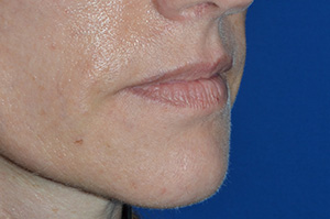 Lip Augmentation Case 4246 Before Photo Lip Augmentation