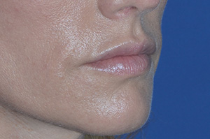 Lip Augmentation Case 4246 After Photo Lip Augmentation
