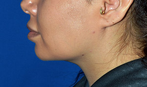 Buccal Fat Reduction Case 4334 After Photo Buccal Fat Reduction