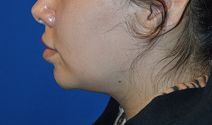 Buccal Fat Reduction Case 4334 Before Photo Buccal Fat Reduction