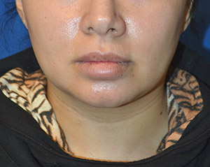 Buccal Fat Reduction Case 4334 Before Photo Buccal Fat Reduction