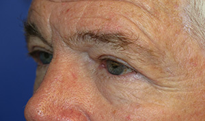 Eyelid Lift Case 4623 After Photo Eyelid Lift