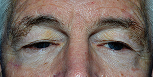 Eyelid Lift Case 4623 Before Photo Eyelid Lift