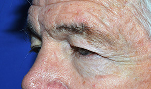 Eyelid Lift Case 4623 Before Photo Eyelid Lift