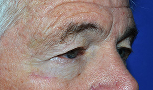 Eyelid Lift Case 4623 Before Photo Eyelid Lift