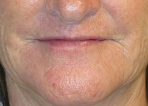 Laser Resurfacing