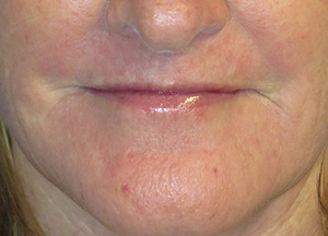 Laser Resurfacing