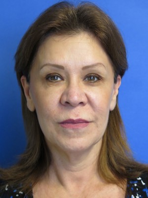 FACEology Lift / Neck Lift Case 4690 Before Photo FACEology Lift / Neck Lift