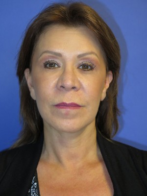 FACEology Lift / Neck Lift Case 4690 After Photo FACEology Lift / Neck Lift
