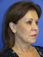 FACEology Lift / Neck Lift