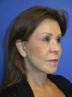 FACEology Lift / Neck Lift