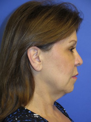 FACEology Lift / Neck Lift Case 4690 Before Photo FACEology Lift / Neck Lift