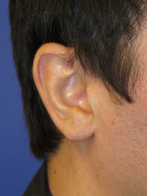Ear Surgery Case 4730 After Photo Ear Surgery