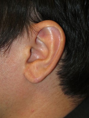 Ear Surgery Case 4730 After Photo Ear Surgery