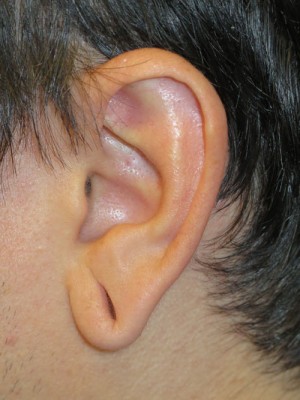 Ear Surgery Case 4730 Before Photo Ear Surgery