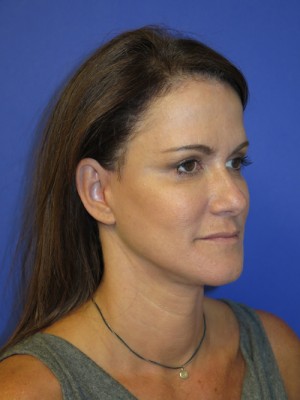 FACEology Lift / Neck Lift Case 4743 After Photo FACEology Lift / Neck Lift