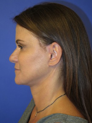 FACEology Lift / Neck Lift Case 4743 After Photo FACEology Lift / Neck Lift