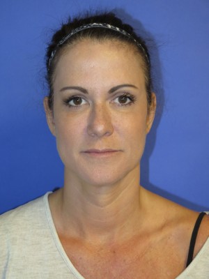 FACEology Lift / Neck Lift Case 4743 Before Photo FACEology Lift / Neck Lift