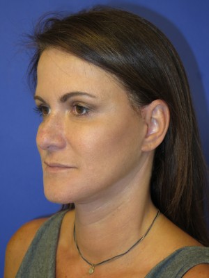 FACEology Lift / Neck Lift Case 4743 After Photo FACEology Lift / Neck Lift