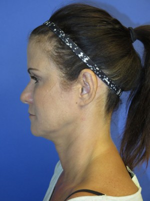 FACEology Lift / Neck Lift Case 4743 Before Photo FACEology Lift / Neck Lift