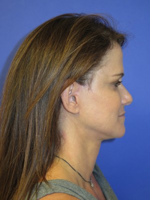 FACEology Lift / Neck Lift Case 4743 After Photo FACEology Lift / Neck Lift