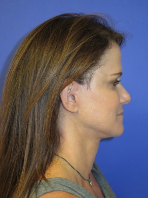 FACEology Lift / Neck Lift