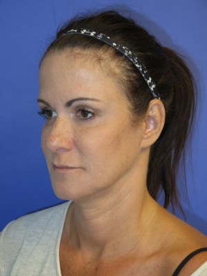 FACEology Lift / Neck Lift Case 4743 Before Photo FACEology Lift / Neck Lift
