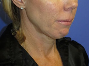 FACEology Lift / Neck Lift Case 4761 Before Photo FACEology Lift / Neck Lift