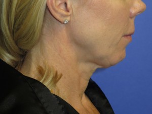FACEology Lift / Neck Lift Case 4761 Before Photo FACEology Lift / Neck Lift