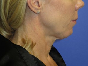 FACEology Lift / Neck Lift