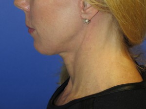 FACEology Lift / Neck Lift Case 4761 After Photo FACEology Lift / Neck Lift