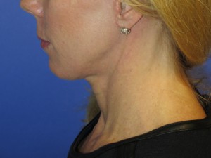 FACEology Lift / Neck Lift