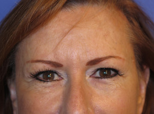 Brow Lift Case 4801 After Photo Brow Lift