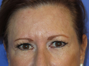 Brow Lift Case 4801 Before Photo Brow Lift