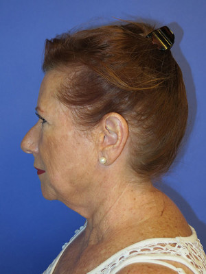 FACEology Lift / Neck Lift Case 4808 Before Photo FACEology Lift / Neck Lift