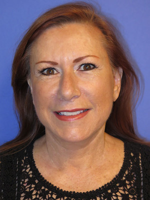 FACEology Lift / Neck Lift Case 4808 After Photo FACEology Lift / Neck Lift