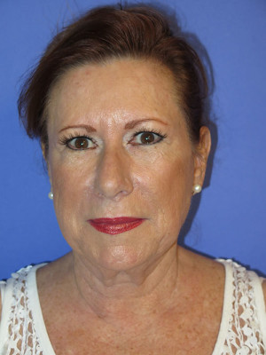 FACEology Lift / Neck Lift Case 4808 Before Photo FACEology Lift / Neck Lift