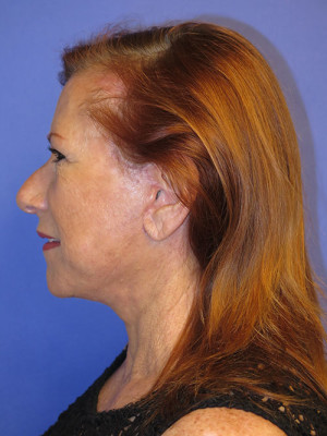 FACEology Lift / Neck Lift Case 4808 After Photo FACEology Lift / Neck Lift