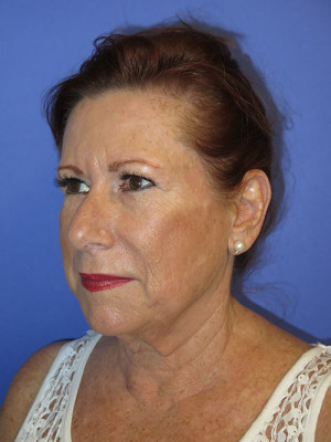 FACEology Lift / Neck Lift Case 4808 Before Photo FACEology Lift / Neck Lift