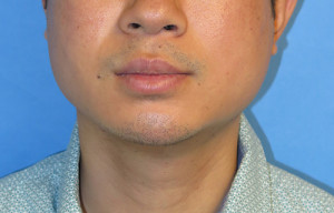 Chin Implant