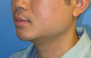 Chin Implant