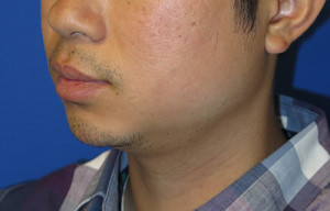 Chin Implant