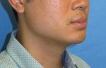 Chin Implant