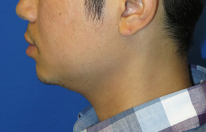 Chin Implant