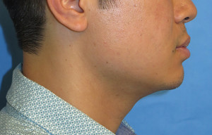 Chin Implant