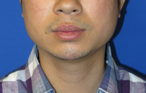 Chin Implant