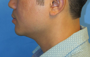 Chin Implant