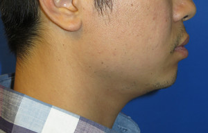 Chin Implant