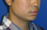 Chin Implant